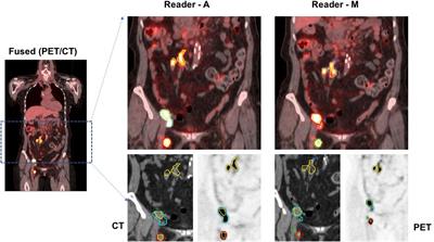 Repeatability of metabolic tumor burden and lesion glycolysis between clinical readers